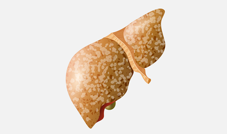 乙肝肝硬化模型